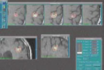 Figure 3: A typical Gamma Knife® treatment plan. Yellow demarcates the prescribed dose; four isocenters are used in this plan. Figure 3: A typical Gamma Knife® treatment plan. Yellow demarcates the prescribed dose; four isocenters are used in this plan.